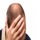 Giải pháp nào kích thích mọc tóc cho người bệnh hói
