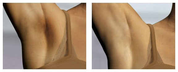 Trước và sau khi sử dụng Kem Daggett & Ramsdell under-arm lightening