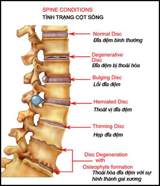 Các bệnh xương khớp thường gặp ở người già