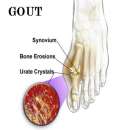 Những điều nên biết về bệnh gút (Gout)