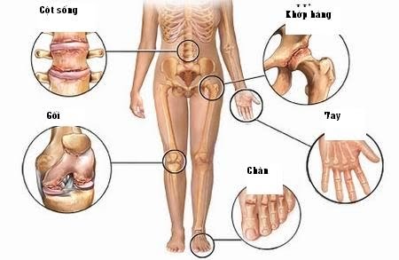 Bệnh viêm đau xương khớp là lớp sụn ở khớp xương bị thoái hóa và ăn mòn