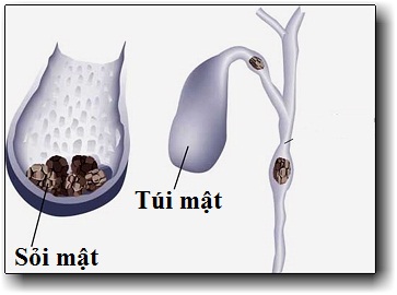 Nguyên nhân và triệu chứng của sỏi mật