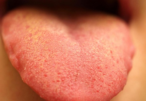 11 biểu hiện của lưỡi chứng tỏ bạn có bệnh trong người