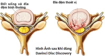 Hình ảnh đối chứng trước và sau khi sử dụng Davince