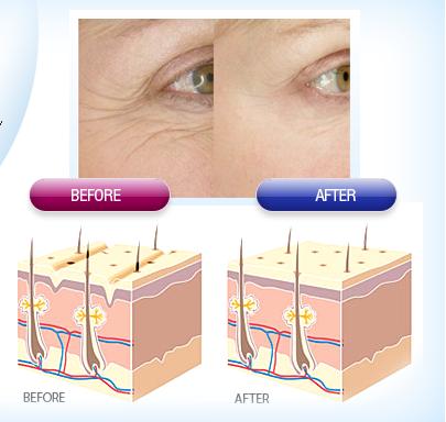Tác dụng của Collagen lên làn da bị nhăn nheo và vết chân chim