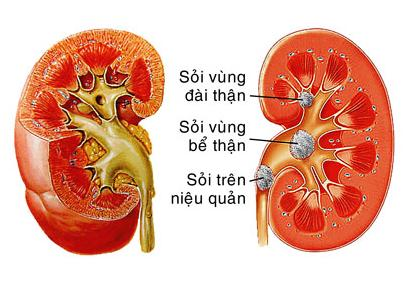 Chanca piedra – viên uống hỗ trợ điều trị sỏi thận 90 viên giải quyết các vấn đề sỏi thận và mật, cũng như các vấn đề khác liên quan đến tiết niệu