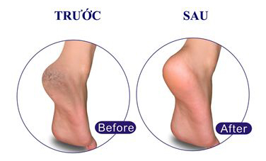 Kem trị nứt nẻ gót chân: neutrogena foot cream 56g