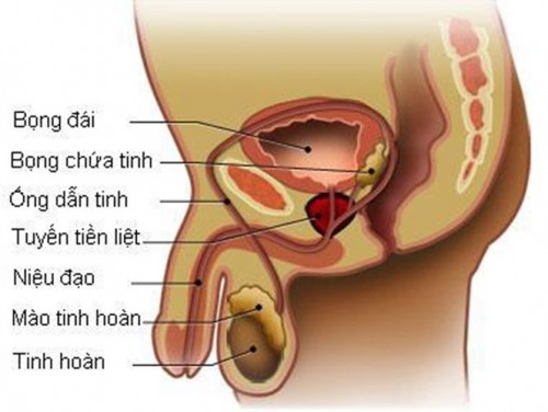 Sơ đồ mô phỏng bệnh Tuyến tiền liệt