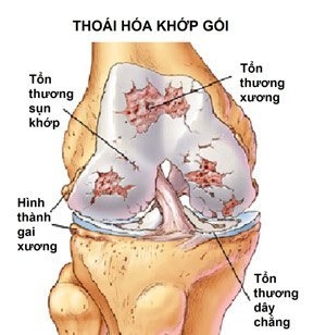 Sơ đồ mô phóng khớp bị tổn thương