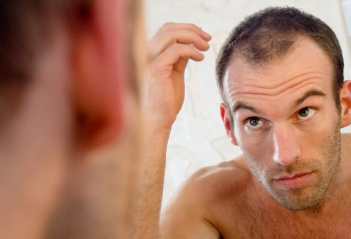 Rụng tóc, hói đầu ảnh hưởng đến hình ảnh của nam giới