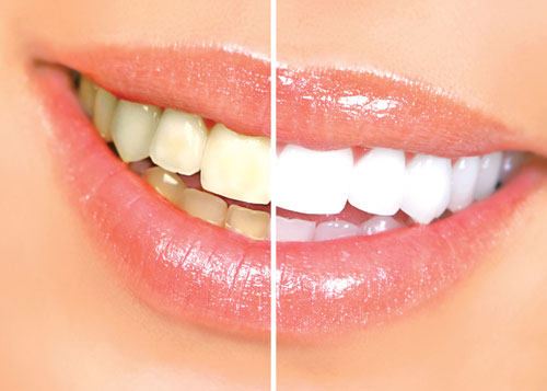 Tác dụng của kem đánh răng làm trắng perfeckt weiss