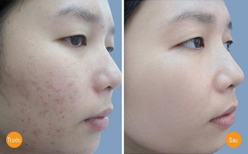 Tinh chất đặc trị và ngăn ngừa mụn laneige pore trouble 30ml