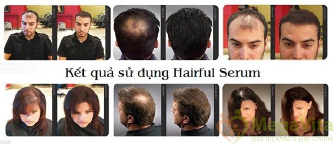 Hairful serum 50ml: chống rụng tóc, kích thích mọc râu, tóc hiệu quả của mỹ