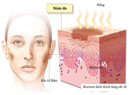 Kem trị tàn nhang, trị nám nhau thai cừu rebirth placenta anti - wrinkle cream 30ml