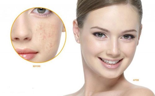 Kem trị nám, trị tàn nhang nhau thai cừu rebirth placenta anti - wrinkle cream 100ml