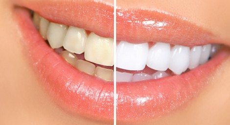Kem Đánh răng mỹ crest 3d white luxe glamorous white 116g - loại bỏ 90% vết ố chỉ trong 5 ngày