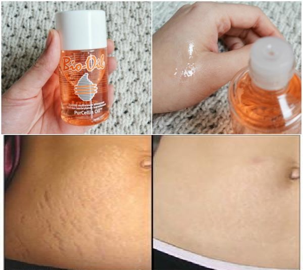 Bio-oil 60ml - Úc: tinh dầu massage chống rạn da, mờ sẹo, thâm
