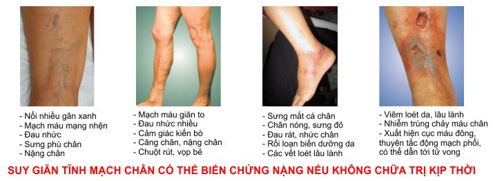 Viên uống hỗ trợ điều trị suy giãn tĩnh mạch giảm đau nhức chuột rút phù nề chân nature's way leg veins support blend của mỹ hộp 60 viên