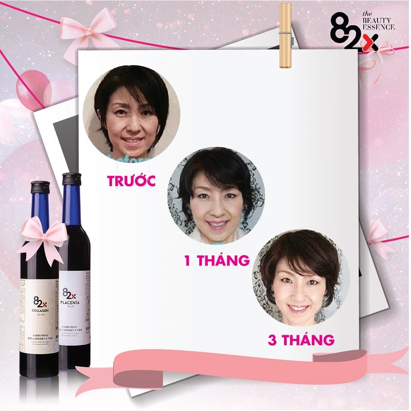 Placenta 82x 450000mg tinh chất nhau thai heo trị nám da, chóng lão hóa và sáng da