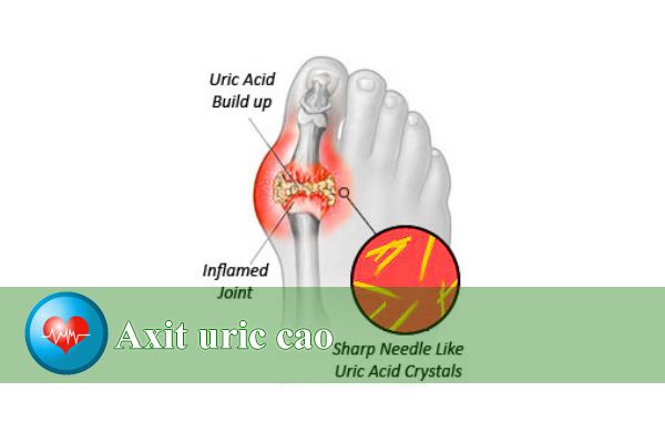 Bio nutrition gout out: hỗ trợ bệnh gút, giảm aric acid từ mỹ 60 viên